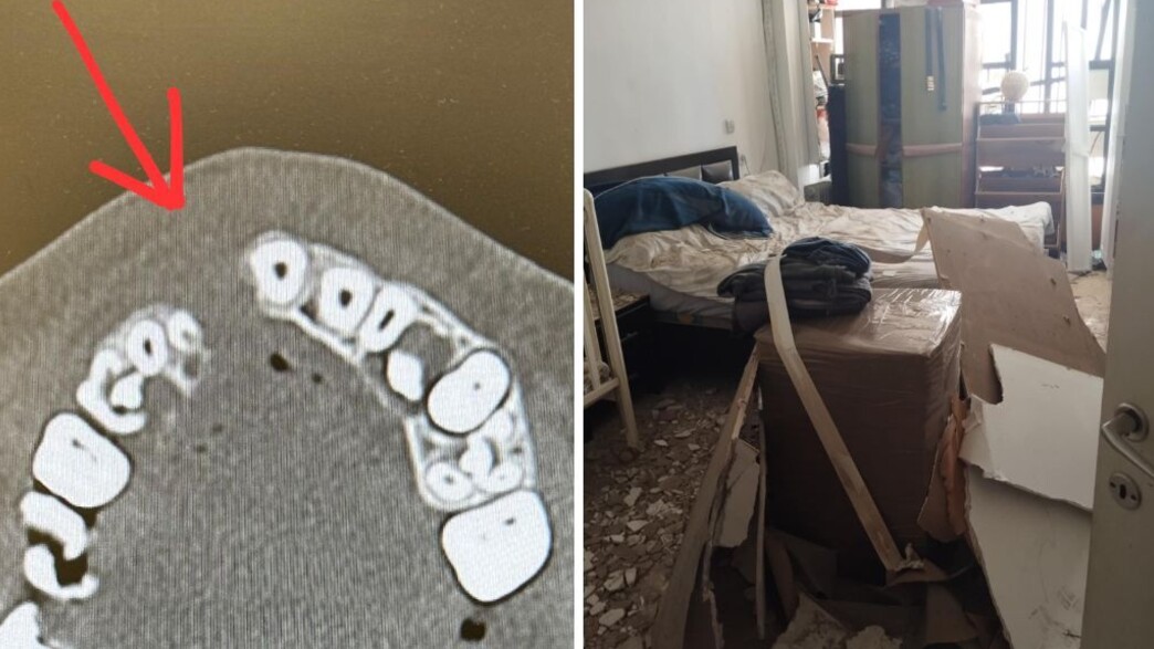 הבית נהרס מהטיל הילד עבר ניתוח מורכב הבית נהרס מהטיל הילד עבר ניתוח מורכב