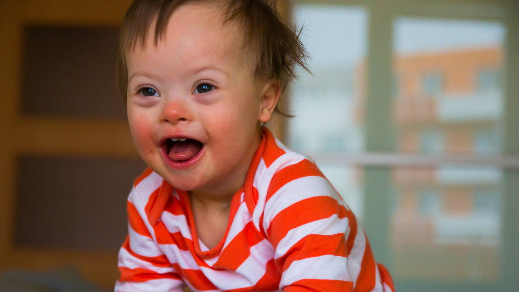 תסמונת דאון תסמונת דאון