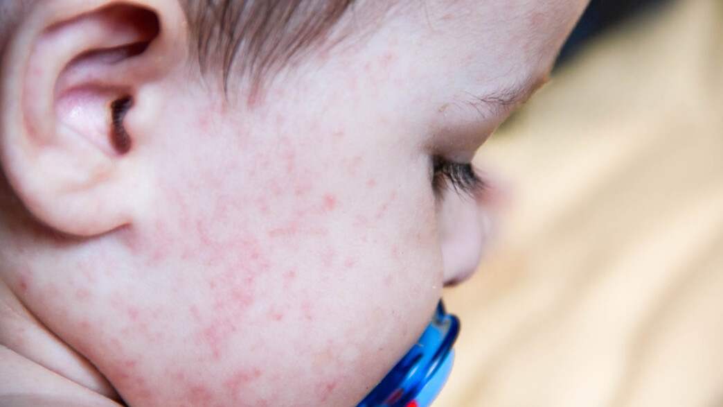 לחים אדומות לחים אדומות