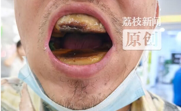 הסיני שעשה לעצמו שיניים תותבות בזול (צילום: רשתות חברתיות לפי סעיף 27 א')