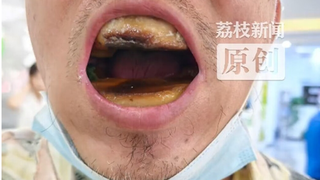 הסיני שעשה לעצמו שיניים תותבות בזול