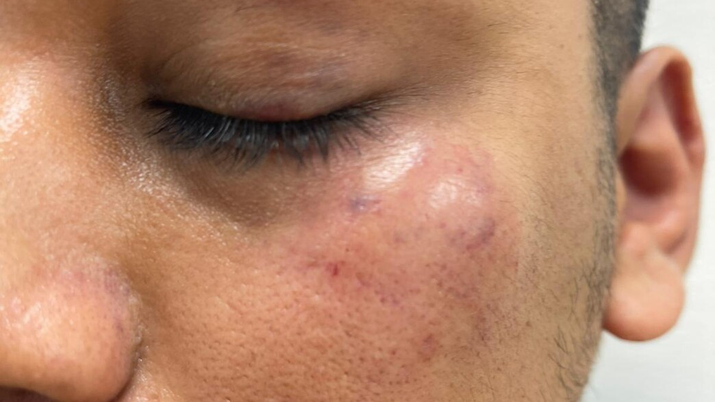 תושב דימונה חווה אלימות קשה ונסחט על רקע הומופובי תושב דימונה חווה אלימות קשה ונסחט על רקע הומופובי