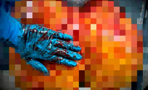 כבד מוגדל (צילום: מתוך הרשתות החברתיות בהתאם לסעיף 27א' בחוק)