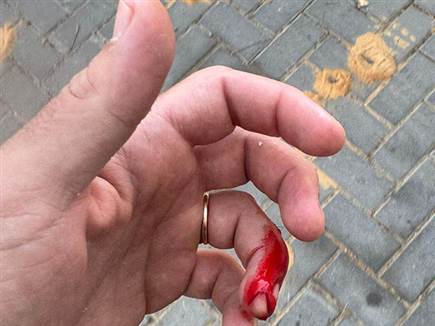 פציעת השוטר (דוברות המשטרה) פציעת השוטר (דוברות המשטרה)