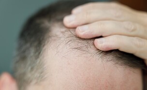 גבר מקריח (צילום: shutterstock)