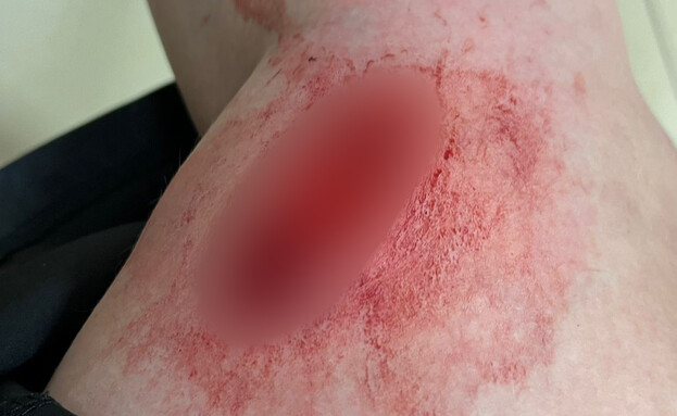 אישה הותקפה על ידי חזיר בר