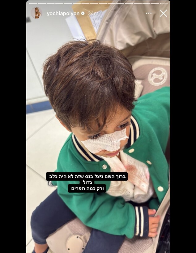 יוכי אפוליאון משתפת שבנה הותקף על ידי כלב