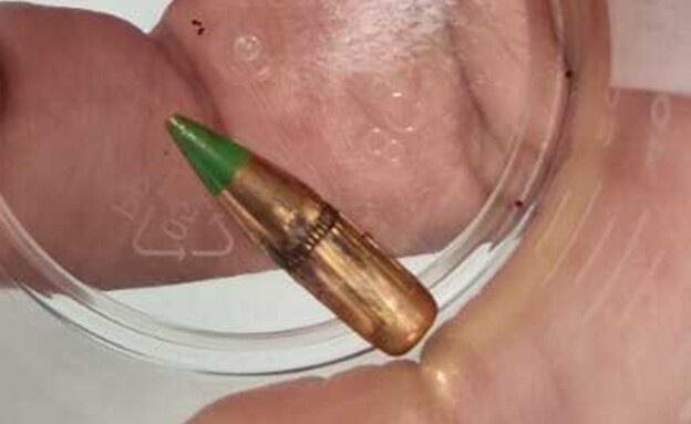 עמירם דביר, שכדור תועה פגע בצווארו עמירם דביר, שכדור תועה פגע בצווארו