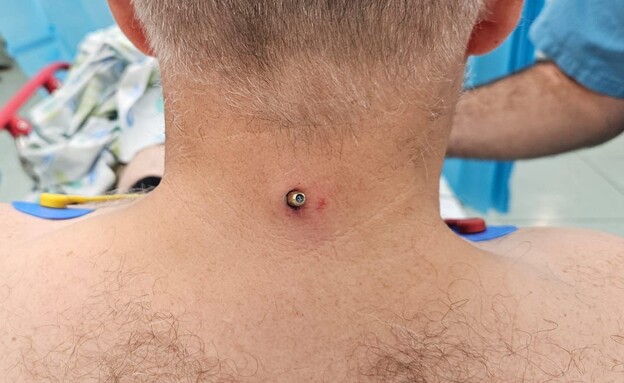 עמירם דביר, שכדור תועה פגע בצווארו עמירם דביר, שכדור תועה פגע בצווארו