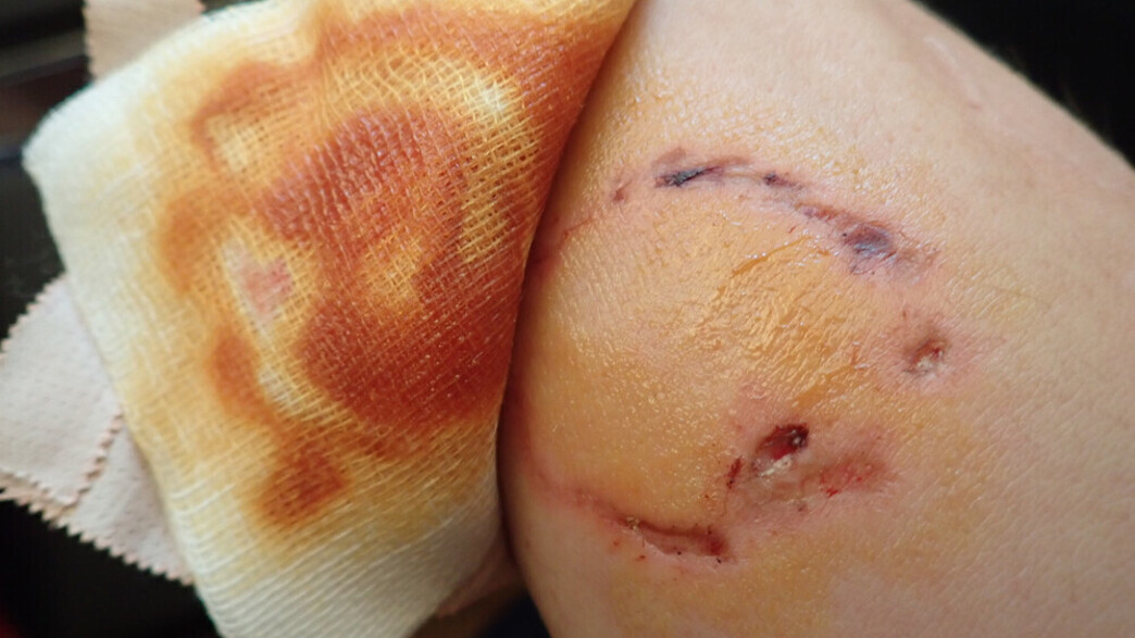 נשיכת כלב נשיכת כלב