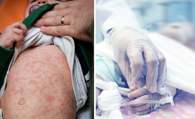 פעוט חולה בחצבת