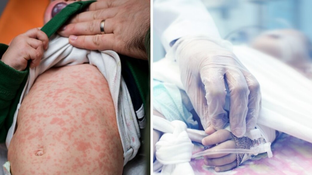 פעוט חולה בחצבת