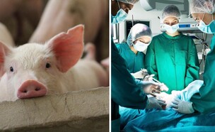 השתלת ריאה מחזיר באדם 