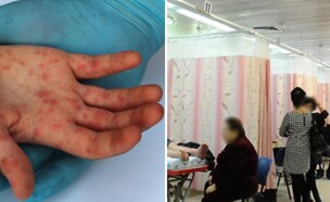 מיון, חצבת (צילום: יוסי זילגר פלאש 90, shutterstock)