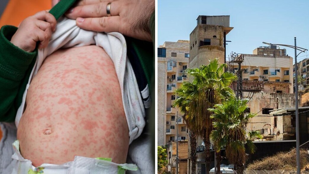 חצבת בטבריה