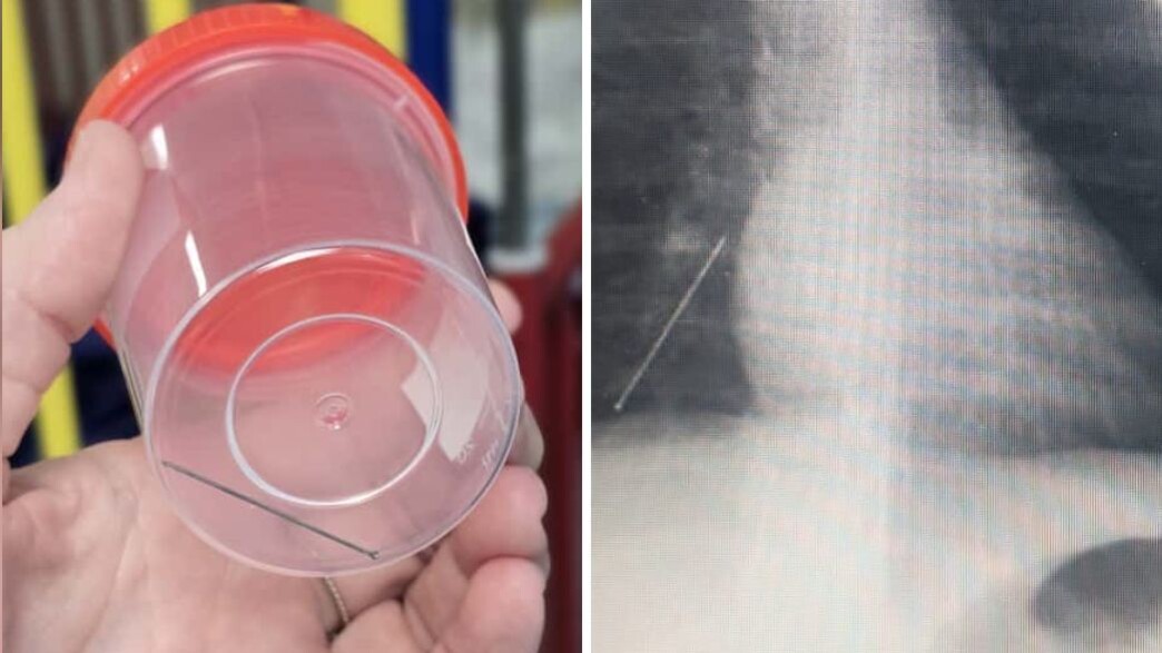 דרמה לילית בחדר ניתוח: חפץ חד הוסר מריאה של פעוטה