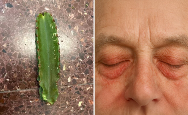 בן 70 כמעט התעוור מקקטוס