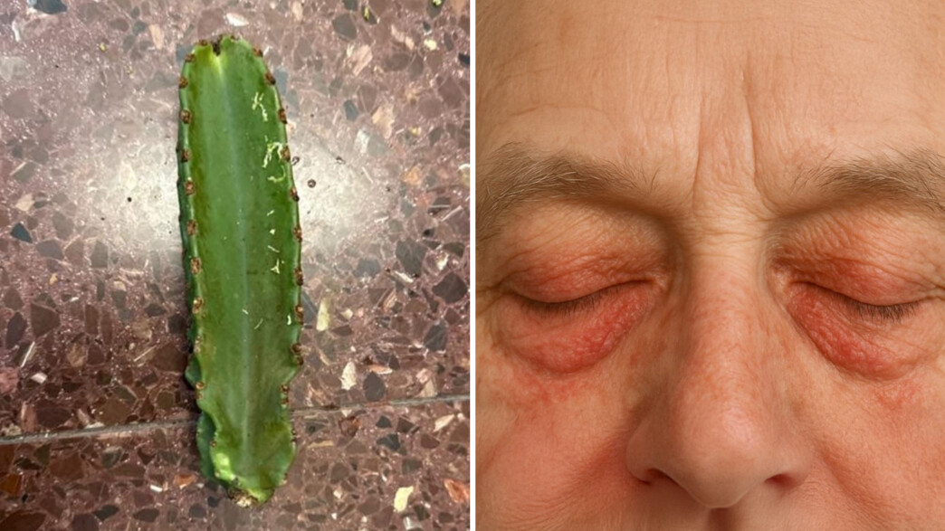 בן 70 כמעט התעוור מקקטוס