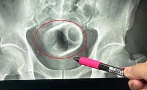 כוס התה שנמצאה בתוך הגבר (צילום: רשתות חברתיות לפי סעיף 27 א')