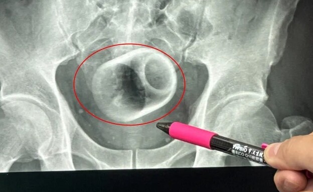 כוס התה שנמצאה בתוך הגבר (צילום: רשתות חברתיות לפי סעיף 27 א')