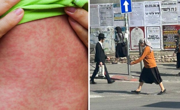 חצבת במאה שערים