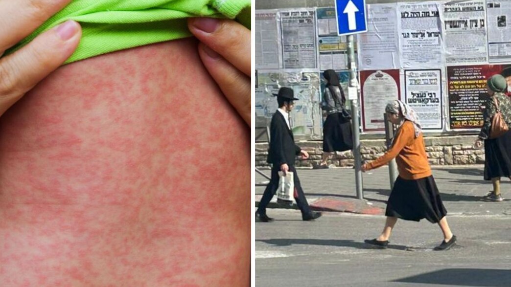 חצבת במאה שערים