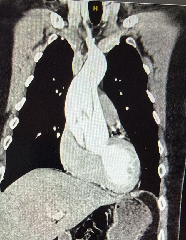 הקרע באבי העורקים של סגן א הקרע באבי העורקים של סגן א