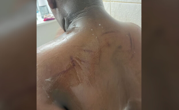 ילד בן 11 על הרצף הוכה בגב בבית ספרו