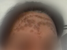 "אני שבר כלי מאז": הטיפול הנפוץ נגמר בצלקות נוראיות