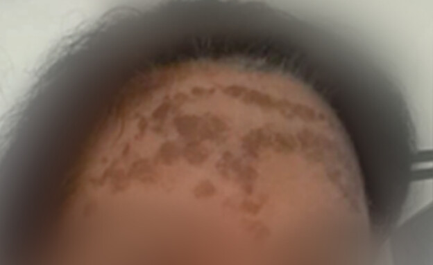 הטיפול הכושל