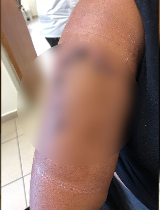 הפציעה של טדלה ביאדגה כתוצאה מהתקיפה הפציעה של טדלה ביאדגה כתוצאה מהתקיפה