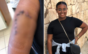 הפציעה של טדלה ביאדגה כתוצאה מהתקיפה (צילום: באדיבות המצולמת)