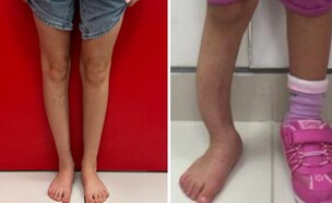 הרגל - לפני ואחרי התהליך המורכב (צילום: רמב"ם)