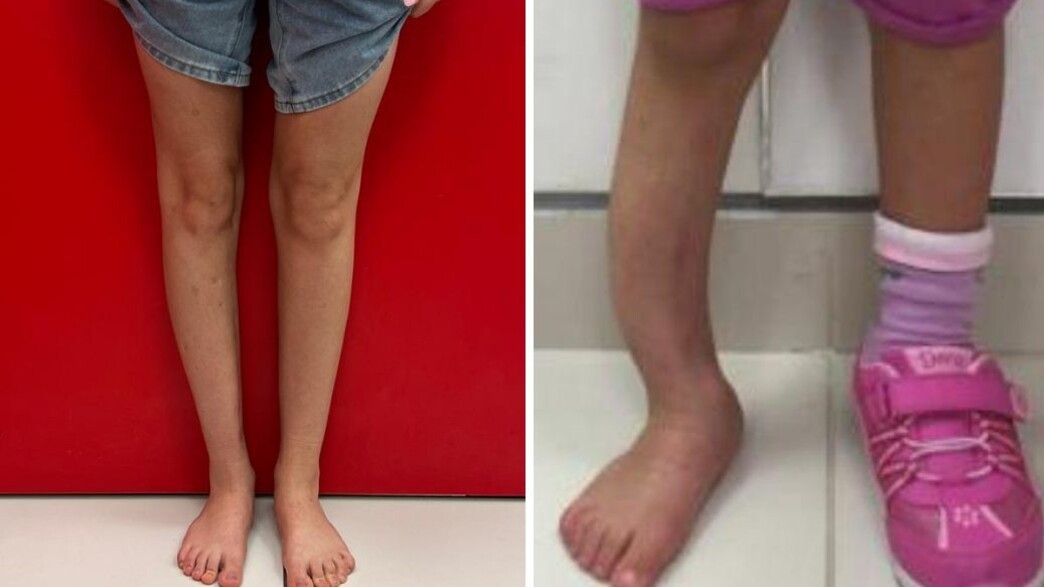 הרגל - לפני ואחרי התהליך המורכב הרגל - לפני ואחרי התהליך המורכב