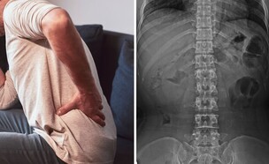 תסמונת גב הסוס (צילום: שאטרסטוק)