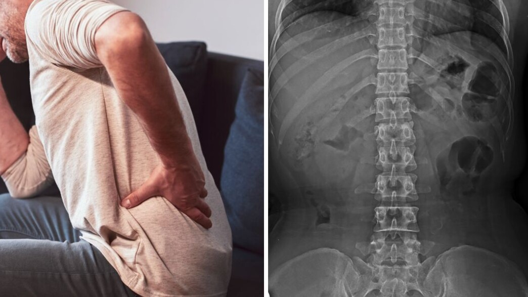 תסמונת גב הסוס תסמונת גב הסוס