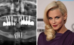 שתלים והנזק הלא מוכר (צילום: ג'ני - שאטרסטוק DFree)