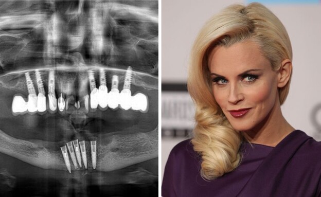 שתלים והנזק הלא מוכר