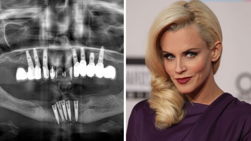 שתלים והנזק הלא מוכר שתלים והנזק הלא מוכר