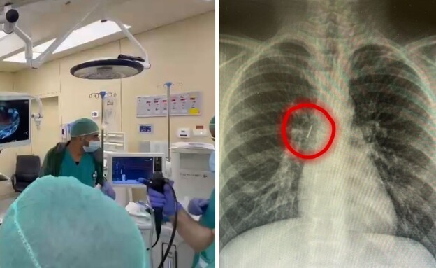 שאפו מחט שאפו מחט