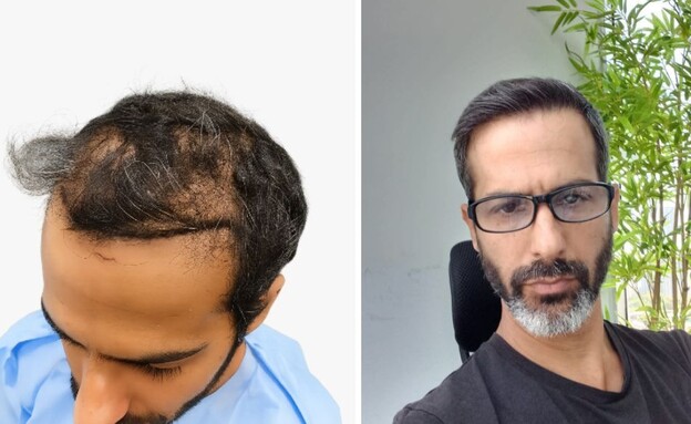 השתלות שיער, דורון כץ