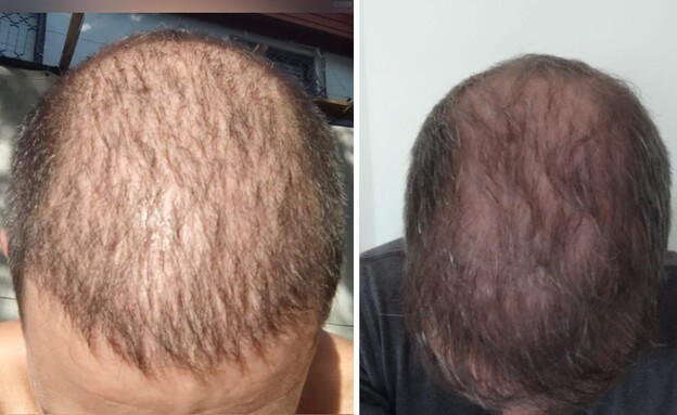  השתלות שיער, ארז