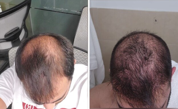 השתלות שיער, מאור