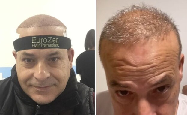  השתלות שיער, מאיר