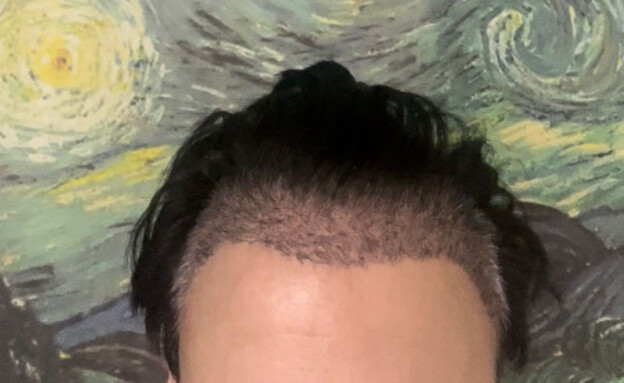 השתלות שיער, מאור