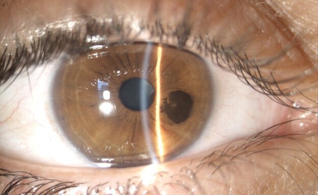 כתם בעין (צילום: מדיקה)