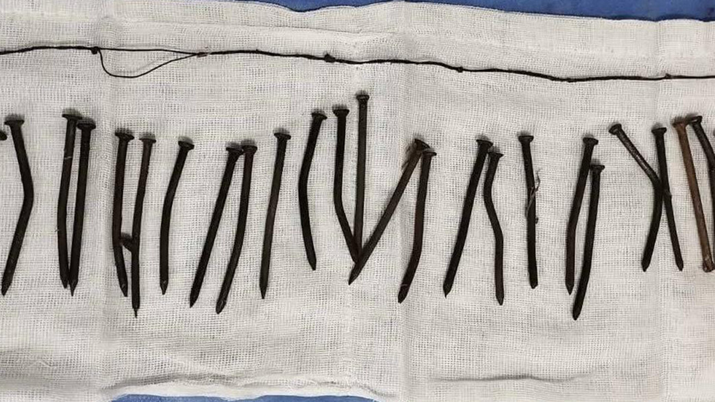 מסמרים שחולצו מקיבתה של מטופלת במצרים