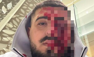 ישראלי הותקף בקפריסין (צילום: צילום מסך)