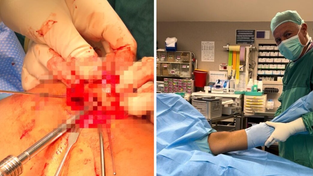 השתלת סחוס מאלמוגים