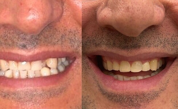 יישור שיניים באמצעות קשתיות 